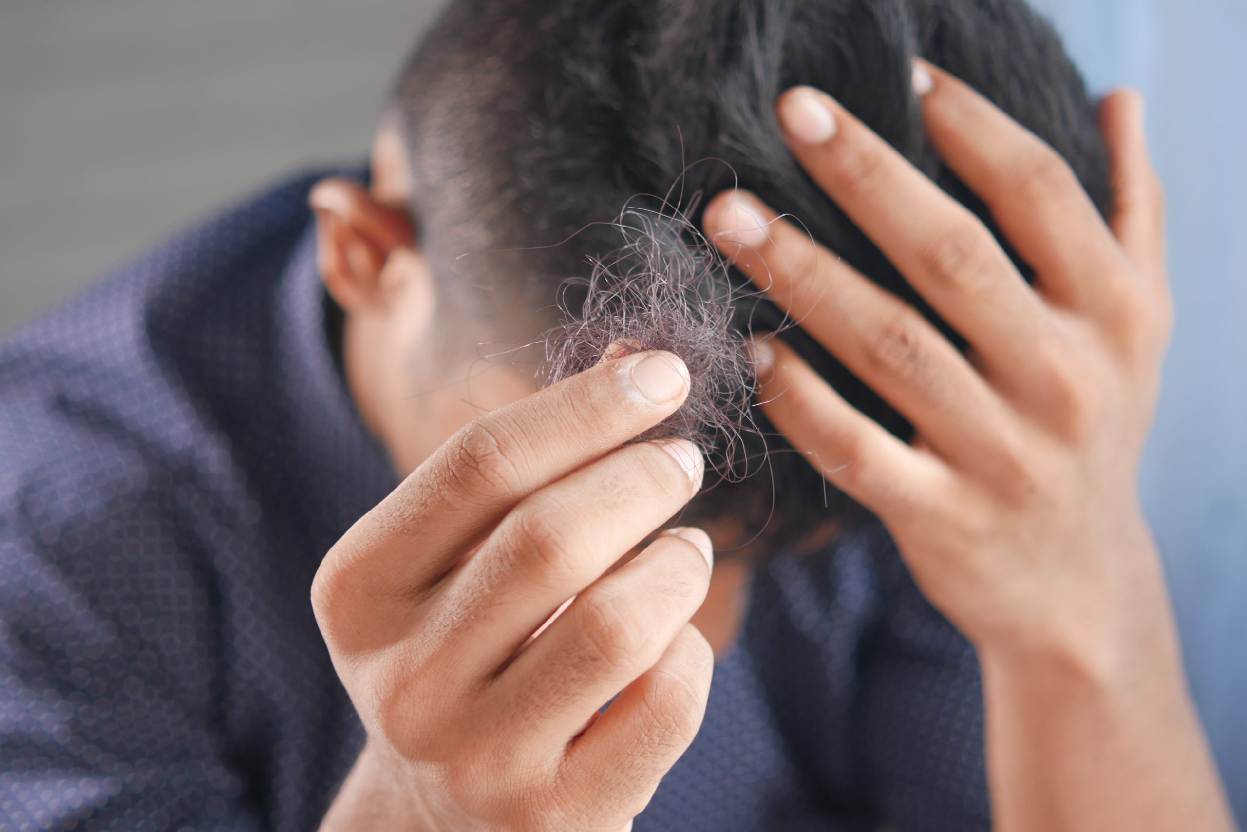Nadmerné vypadávanie vlasov: aké je príčina a existuje liek?