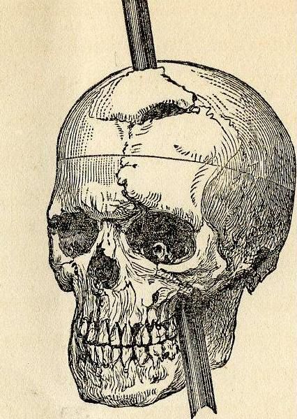 Phineas Gage