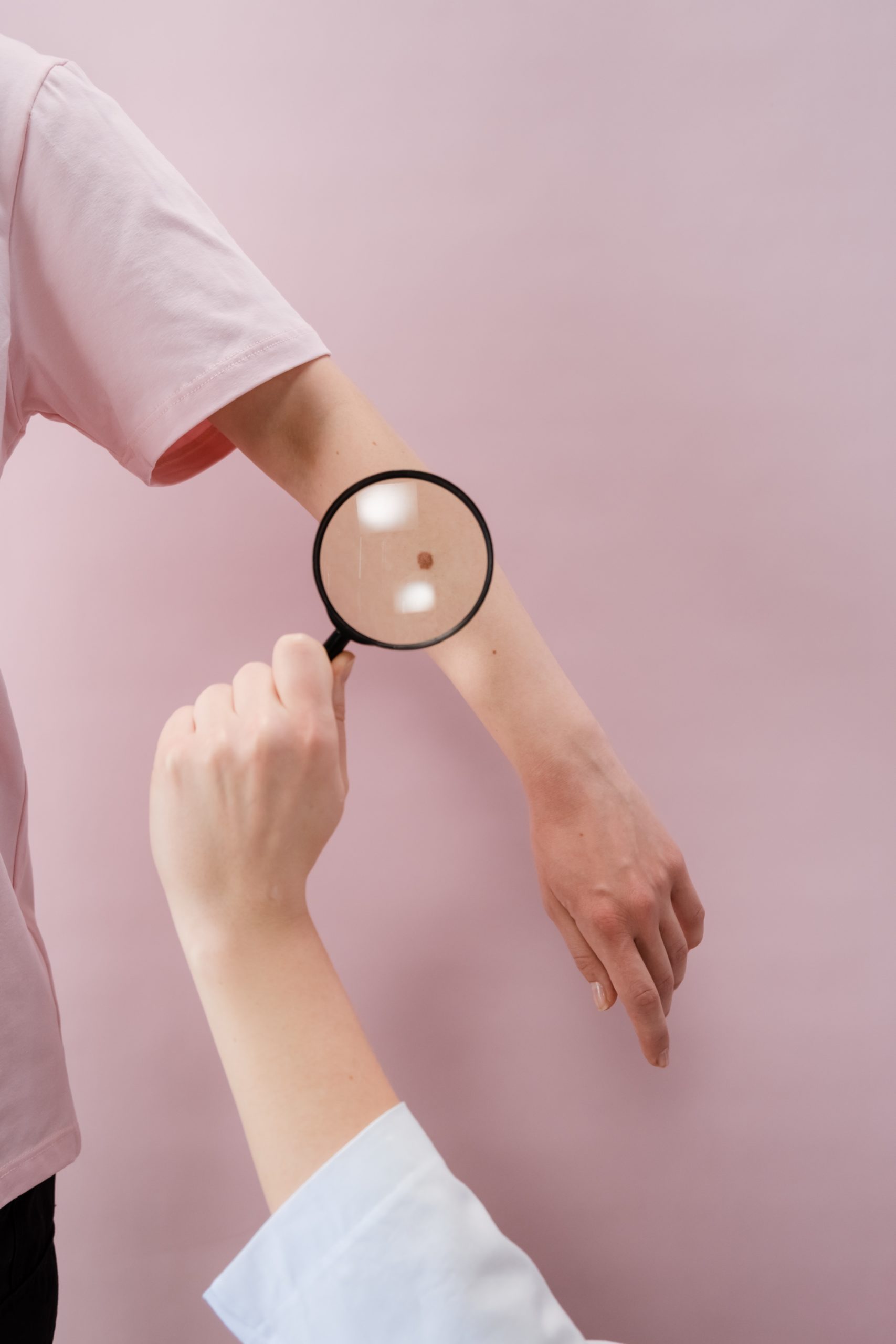 Rakovina kože nie je len o znamienkach. Ako vzniká a kedy navštíviť lekára?