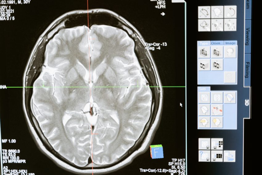 Alzheimerova choroba